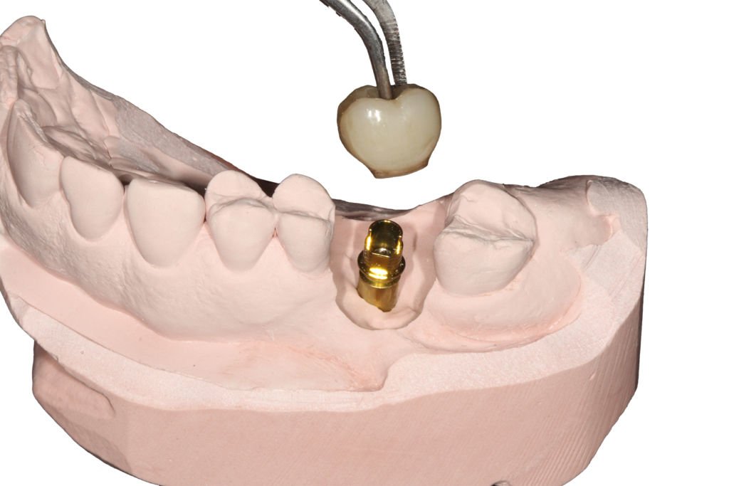 How to Cement Ti-Bases to Zirconia Crowns Using Microetching and Resin